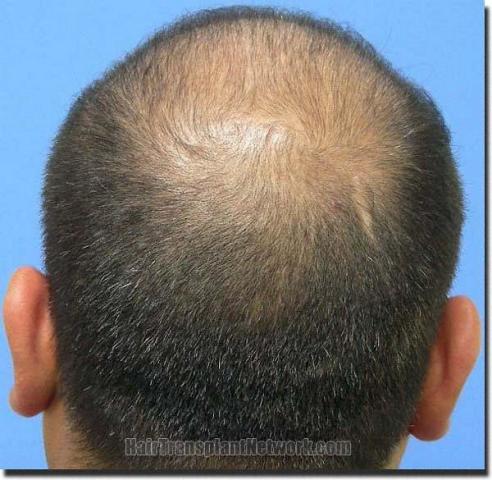 Hair restoration procedure results