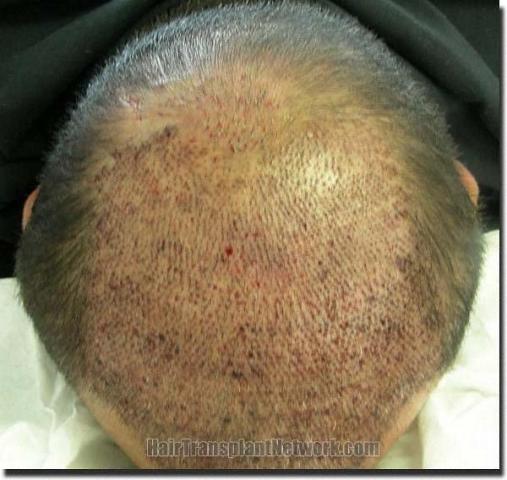 Hair restoration procedure results