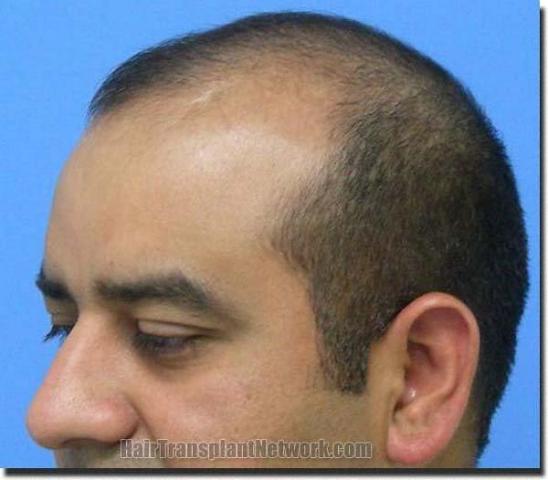 Hair restoration procedure results