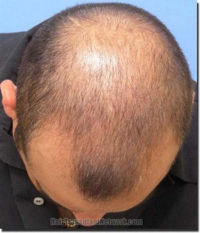 Hair restoration procedure results