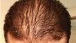 Can You Have A Hair Transplant With Diffuse Hair Loss?