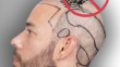 Do You Have To Shave Your Head For A Hair Transplant?