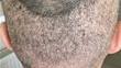 Hair Transplant Surgery Donor Depletion or Shock Loss?
