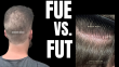 FUE vs FUT Hair Transplant: Which Is Better for You?