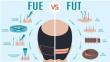 What Are The Advantages and Disadvantages of FUE and FUT