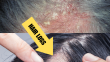 Can Seborrheic Dermatitis Cause Hair Loss?