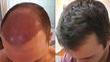 3 Ways To Conceal A Hair Transplant