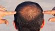 How Many Grafts Are Needed For A Crown Hair Transplant