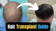 A Guide To Getting A Successful Hair Transplant