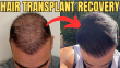 Everything You Need to Know About Hair Transplant Recovery: A Comprehensive Guide