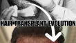 The History and Evolution of The Hair Transplant Industry