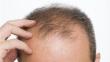 How to cope with hair loss