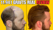 Where To Find Real Hair Transplant Reviews