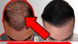 How Long Does Shock Loss Last After A Hair Transplant