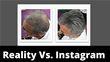 Should You Use Instagram To Research A Hair Transplant Surgeon?