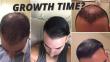 How Long Does It Take For A Hair Transplant To Grow?