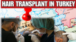 How Turkey Became The Hair Transplant Capitol of the World