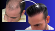 The Hair Transplant Network is The Best Online Resource for Hair Transplantation