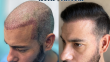 How To Choose The Right Hair Transplant Surgeon