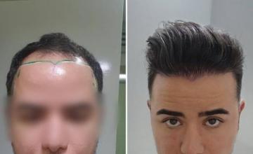 Dr. Pittella - 6401 grafts - 1 sitting - BRAZIL