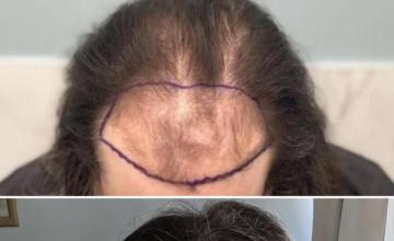 5100 Grafts | Dr. Sean Behnam |