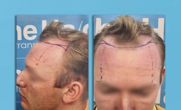 Dr Arshad / The Hair Dr Clinic (Leeds,UK) - 1841 grafts by FUE. 18 month follow up. Hairline restoration.