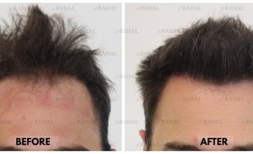 2535 Grafts Via FUE with Dr. H. Rahal