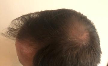 Dr. Arocha | Artistic Hair Restoration | 6000 Grafts Total