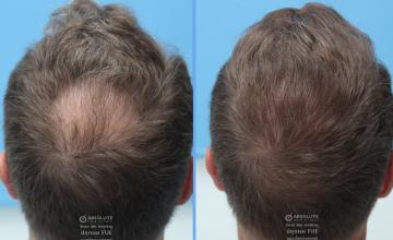 Dr.Kongkiat Laorwong, FISHRS, Thailand, FUE 2437 grafts