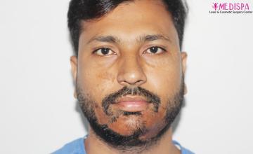 Facial Burn Scar, Beard Reconstruction by Dr. Suneet Soni – 2704 Grafts, FUT Technique