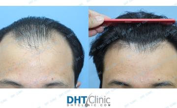 Dr. Damkerng Pathomvanich (DHT Clinic) /FUT 2,240 grafts + oral finasteride and oral minoxidil, 1 year and 5 months post op