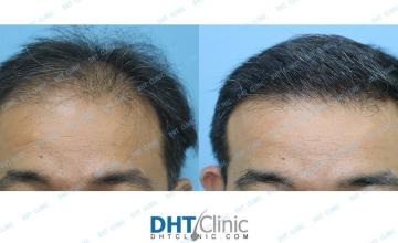 Dr. Damkerng Pathomvanich (DHT Clinic) / COMBO 3,503 grafts (FUT 2,451 grafts/ FUE 835 grafts from scalp/ FUE 217 grafts from beard), 5 months post op