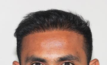 Hair Transplant Repair – 3000 Grafts – Dr. Suneet Soni, Medispa India