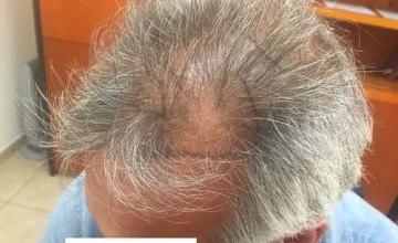 Dr.Christina at HDC clinic, 2800 FUE grafts for 53 years old patient