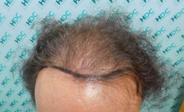 Hair Transplant Outcome with 4000 Grafts Across NW5 Zone – HDC Hair Clinic