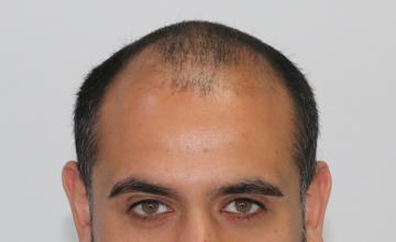 Dr Resul Yaman Hair Clinic - 4450 Grafts Result