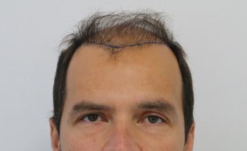 Dr Resul Yaman Hair Clinic - 3650 Grafts First Session Result