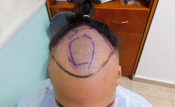 Hairline Hair Transplant Result - 2500 grafts – 1 Year After from HDC Hair Clinic