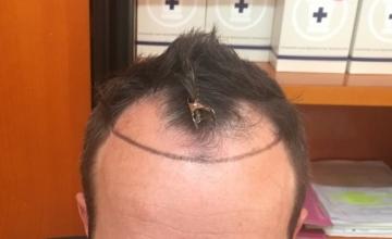 Hairline and temples hair Transplant – 2800 grafts – HDC Hair Clinic