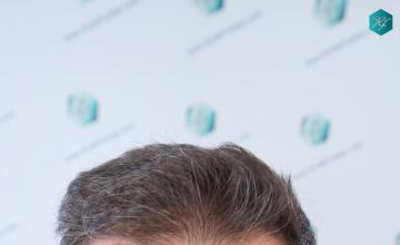 Dr. Rafael de Freitas - 2669 Grafts / 6837 Hairs - FUE