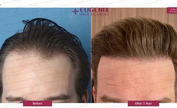 Caucasian Hair Transplantation Result I 1-year Update I @Eugenix Hair Sciences