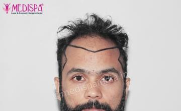 Dr. Suneet Soni - 5320 Grafts, Combine FUT + FUE Technique , NW- IV