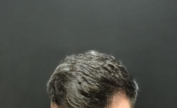 Dr Raghu Reddy- FUE procedure of 1347 grafts- Norwood 3 (12 months post op)