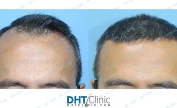 Dr. Damkerng Pathomvanich (DHT Clinic) / FUE 2,082 grafts, 8 months post op