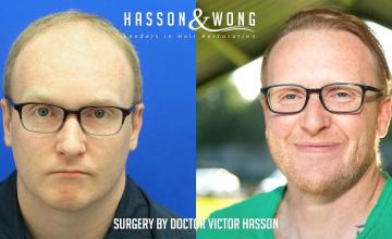 Dr. Hasson /2155 Grafts/ FUE/ 1 Session/ 18 months post-op