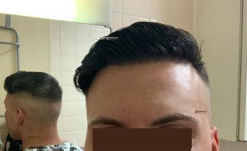 Dr. Kongkiat Laorwong, MD, FISHRS,  FUE 2000 grafts, 12 months post op