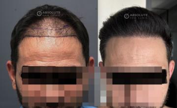 Dr. Kongkiat Laorwong, MD, FISHRS,  FUE 4350 grafts, 8 months post op