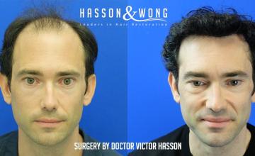 Dr. Hasson / 5,163 grafts / FUE / Stage 6 / 16 months post-op / 2nd for crown / 4050 grafts /  Full Coverage Coming