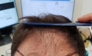HDC Result of 4180 grafts to front and post op of 2850 to crown – Total 7030 grafts.