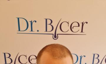 Ozlem Bicer MD-Hair Transplant-3190 Grafts FUE by micro-motor,  6. months result